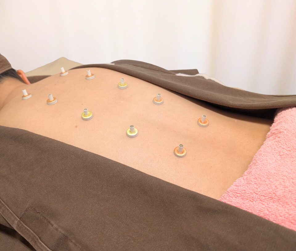 中医学による間接灸