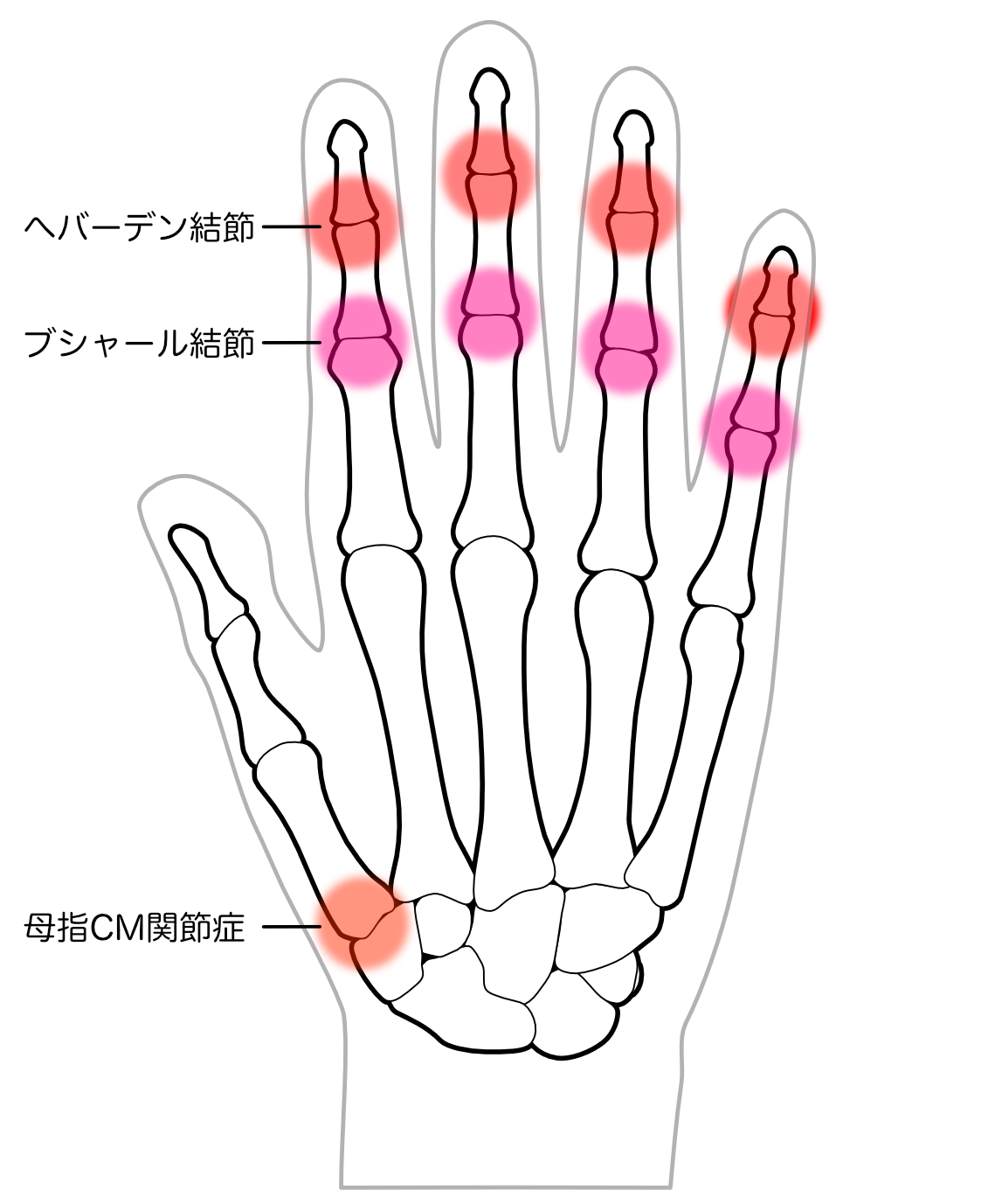 変形性指関節症