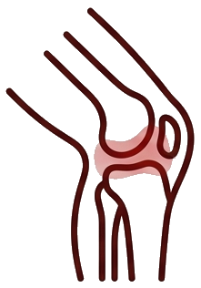 変形性膝関節症
